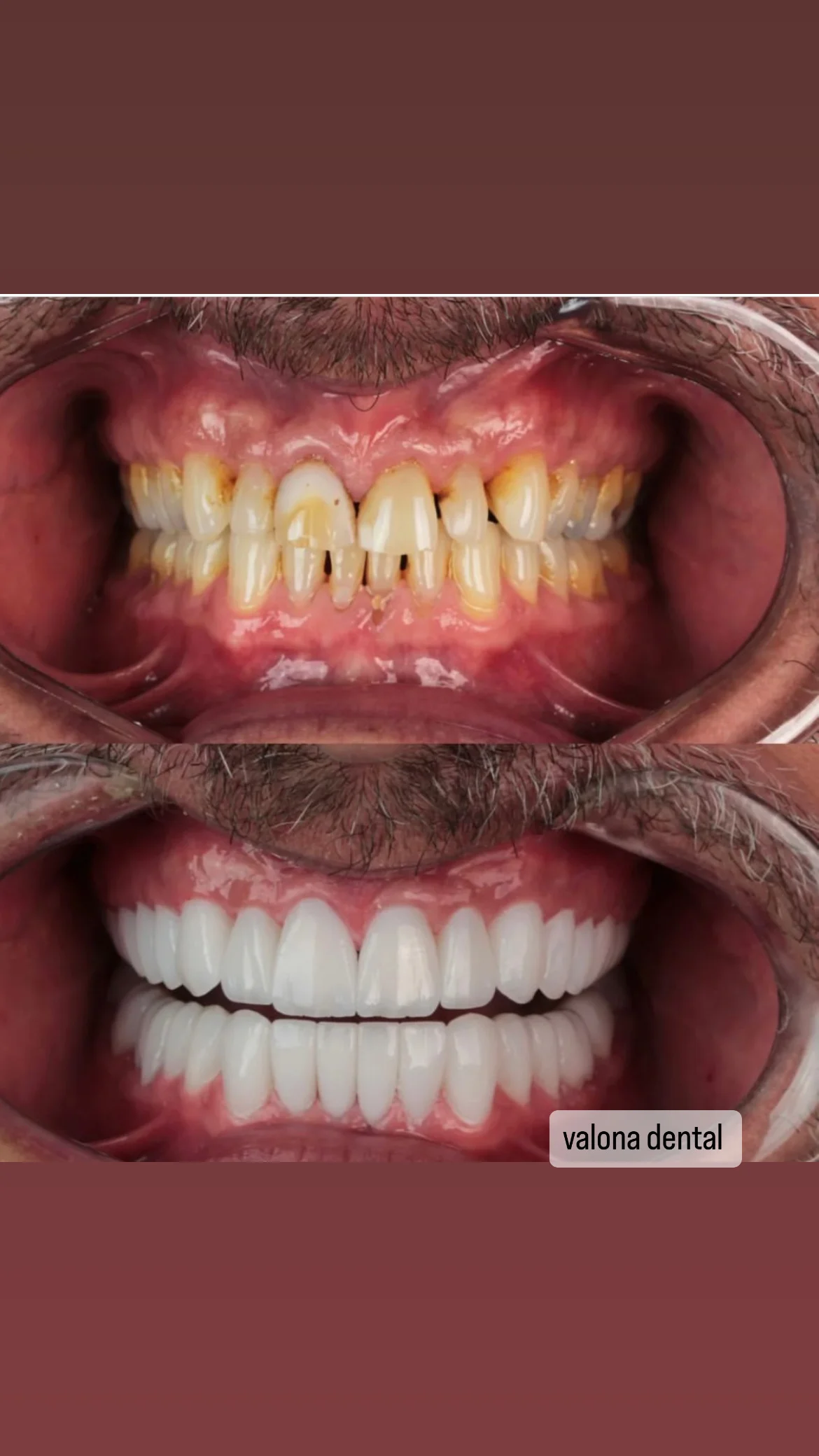 Before and after dental treatment 1