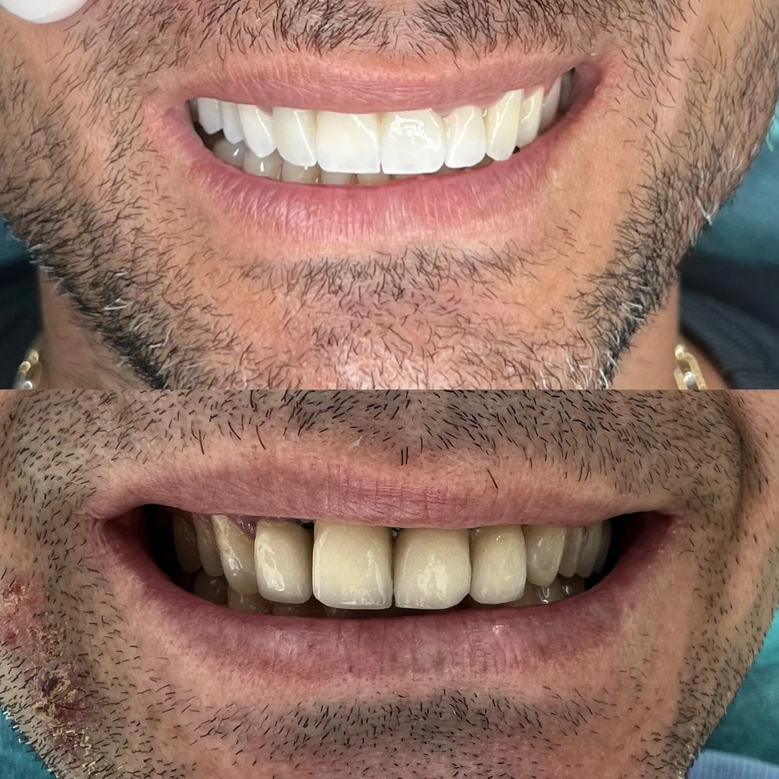 Before and after dental treatment 2