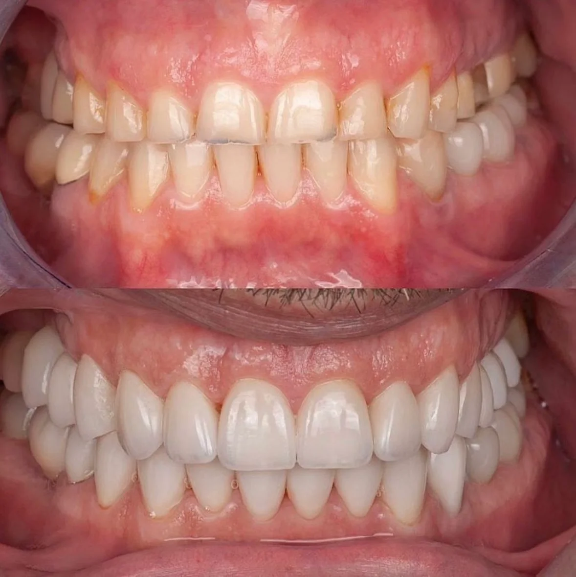 Before and after dental treatment at Valona Dental